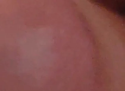 Immense Phimosis Being Extracted Cum and Précum.
