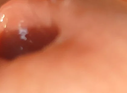 The Great Transformation of Phimosis Elastica.