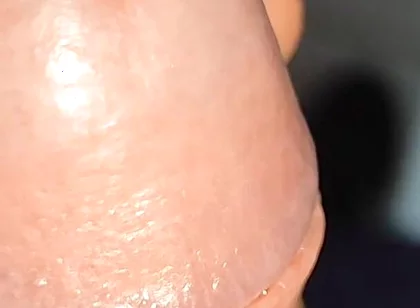 Extreme Application to the Syringe Inside the Glans!!