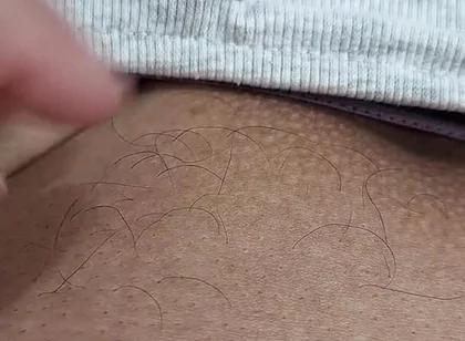 The Hair on My Penis - Led Hair Removal