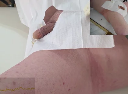 16 French Foley Insertion