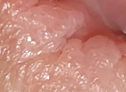 Enlargement of the Deep Urethral Hole!!