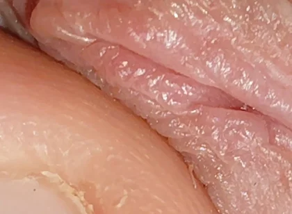 Enlargement of the Deep Urethral Hole!!