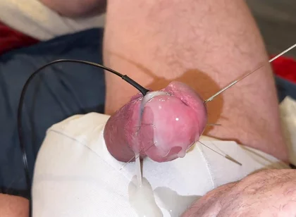 Acupuncture and Extremely Cumshot!