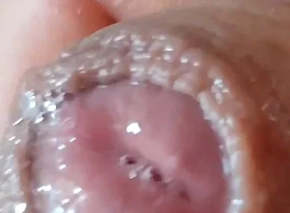 Deep Split in the Glans Produces Bubbling Liquid