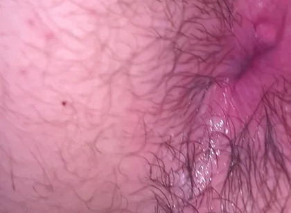 Bruised Asshole