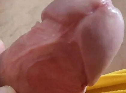 Scarred Frenulum Causes Glans Erection!