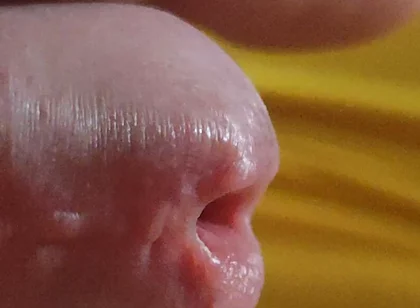 Scarred Frenulum Causes Glans Erection!