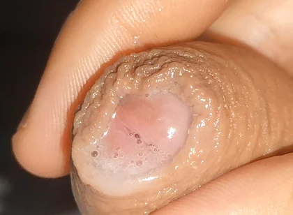 Curious Close-up of Pre-cum in Flaccid Phimosis.