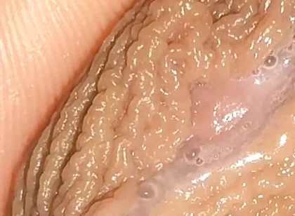 Curious Close-up of Pre-cum in Flaccid Phimosis.