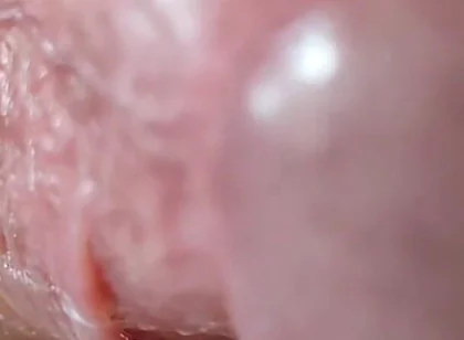 Opening the Scar of the Rough Frenulum!