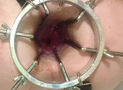 Enema, Anal Shower. Close-up View Through Anal Mirror. Anal with Water. Filling Anal with Water