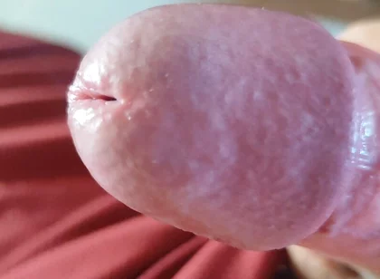 The Blossoming of Extensive Elastic Phimosis.