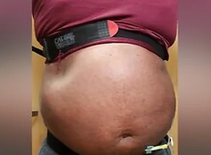 N2o Belly Inflation