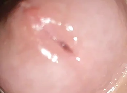 Maximum Dilation of Phimosis Cumming.