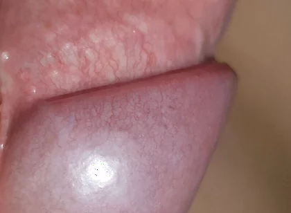 Amazing Upright Rough Venous Frenulum
