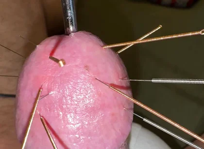 Acupuncture - Orgasm!
