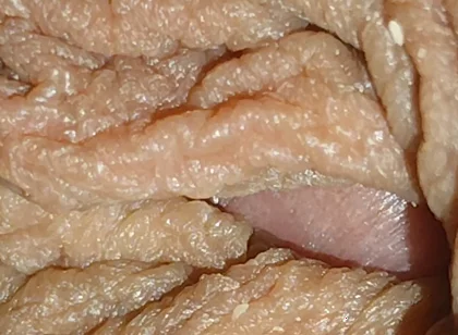 The World's Largest Foreskin Opening and Closing.