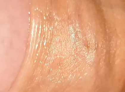 Difficult Fluid Control Due to Straight Phimosis.