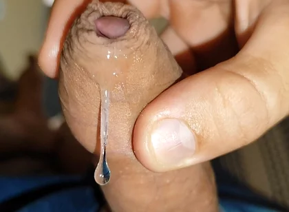 Difficult Fluid Control Due to Straight Phimosis